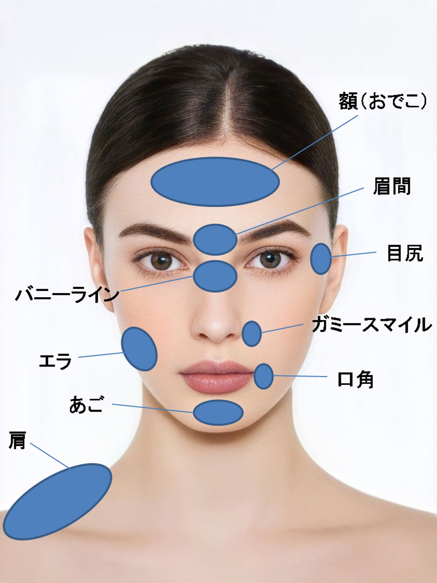 ボツリヌストキシン注射